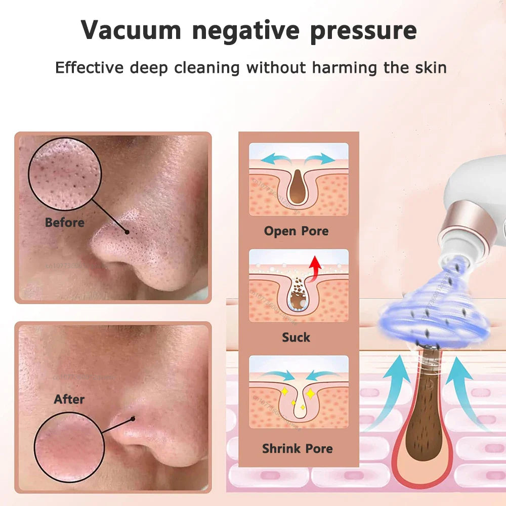 Electric Pore Vacuum Blackhead Remover with Microbubble Technology